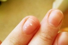 کشف راز لکه های سفید روی ناخن