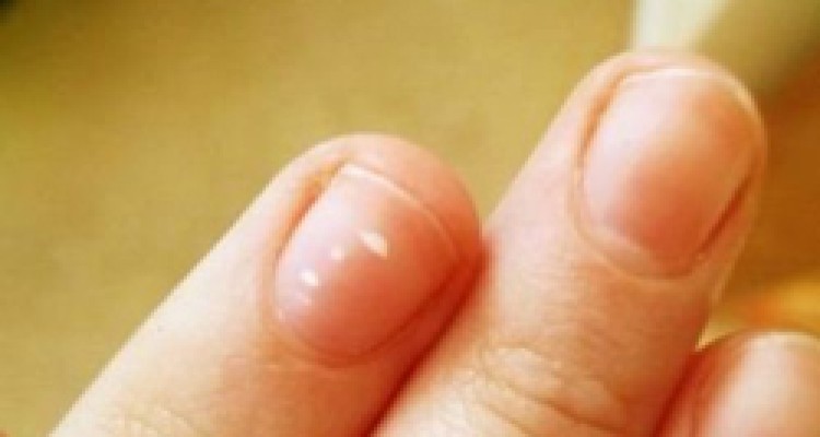 کشف راز لکه های سفید روی ناخن