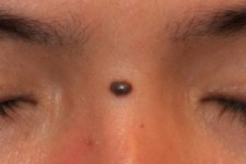 حواستان به خال‌های بدن باشد! 