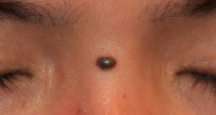 حواستان به خال‌های بدن باشد! 