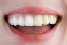 دلایل بدرنگی دندان ها چیست؟ 