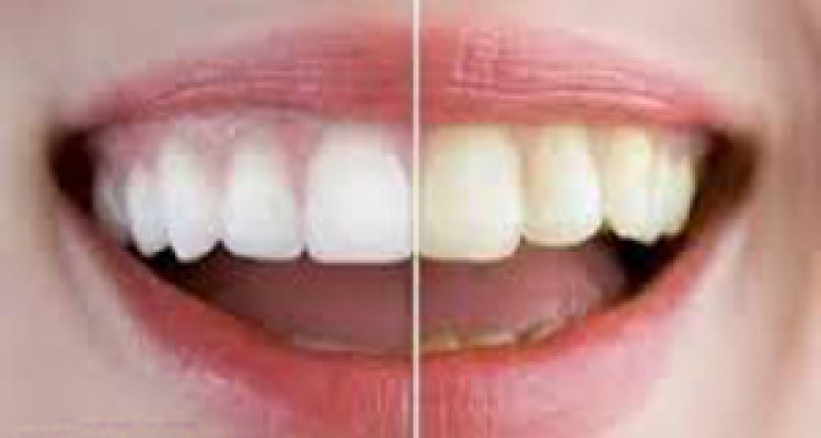 دلایل بدرنگی دندان ها چیست؟ 