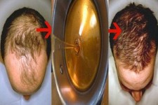 کاشت مو طبیعی خانگی/ با این معجون به طور شگفت‌انگیزی پر مو شوید+دستورالعمل 