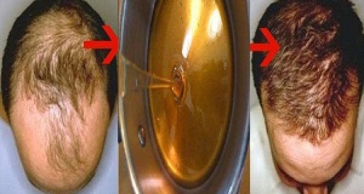 کاشت مو طبیعی خانگی/ با این معجون به طور شگفت‌انگیزی پر مو شوید+دستورالعمل 