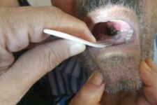 خارج کردن زالو پس از 25روز از دهان پیرمرد 75 ساله/مردم در استفاده از آب چشمه ها مراقب باشند+فیلم و عکس