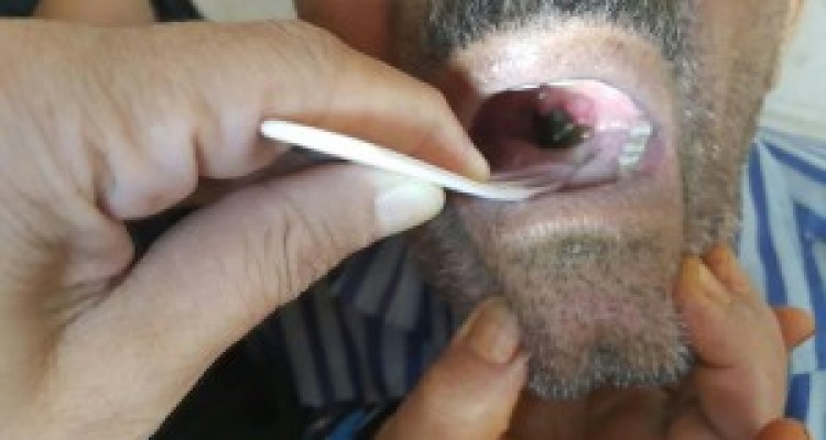 خارج کردن زالو پس از 25روز از دهان پیرمرد 75 ساله/مردم در استفاده از آب چشمه ها مراقب باشند+فیلم و عکس