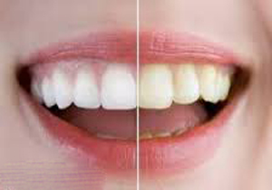 دلایل بدرنگی دندان ها چیست؟ 