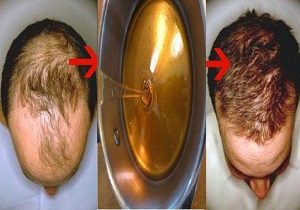 کاشت مو طبیعی خانگی/ با این معجون به طور شگفت‌انگیزی پر مو شوید+دستورالعمل 