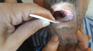 خارج کردن زالو پس از 25روز از دهان پیرمرد 75 ساله/مردم در استفاده از آب چشمه ها مراقب باشند+فیلم و عکس